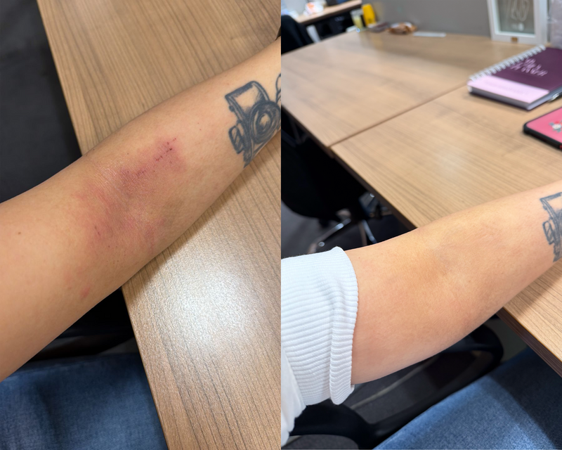 Eczema