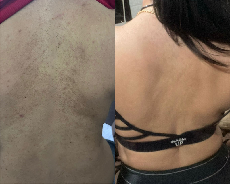 Back Acne
