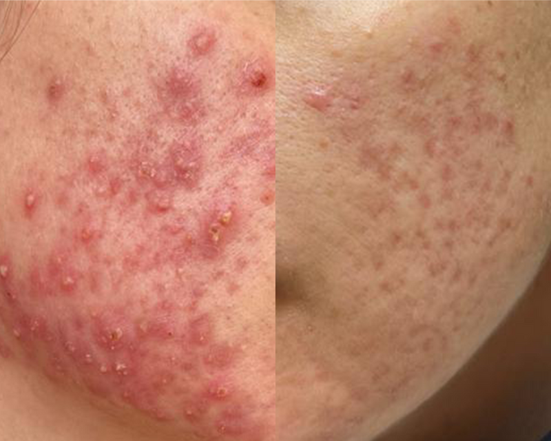 Face Acne (pregnant women)