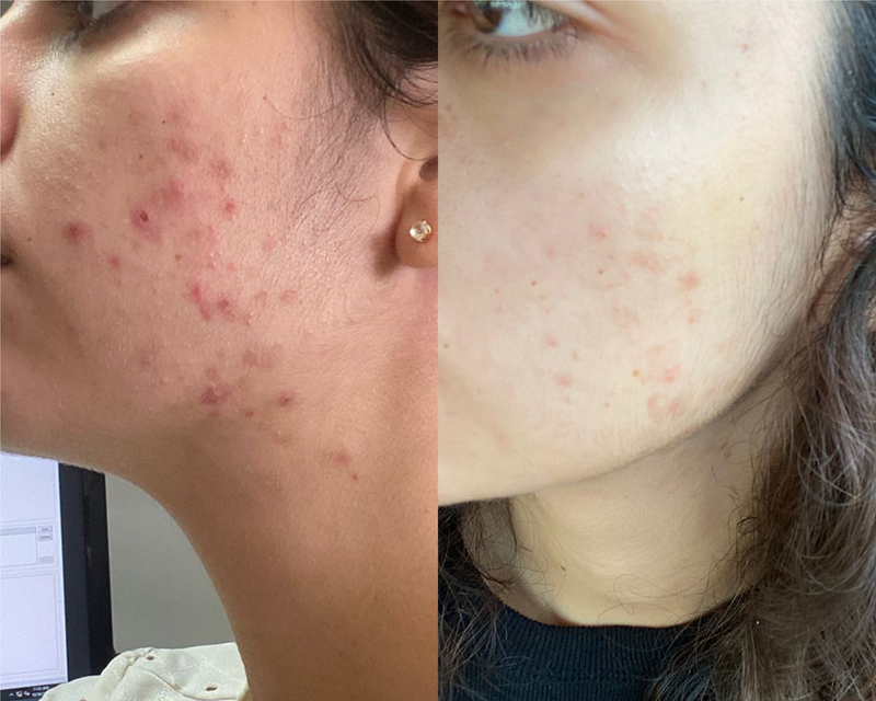 Face Acne