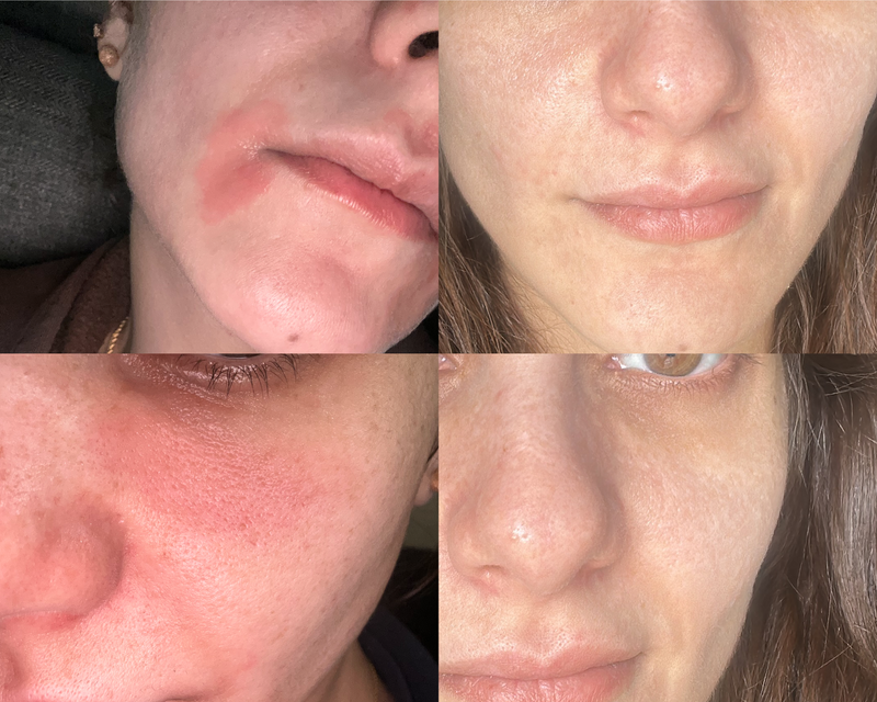 Face Eczema
